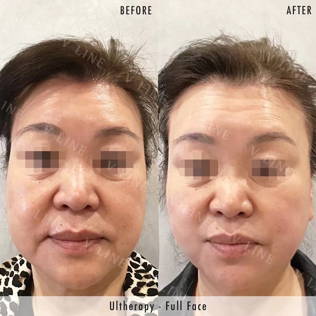 Ultherapy Before & After Gallery - Patient 133227592 - Image 3