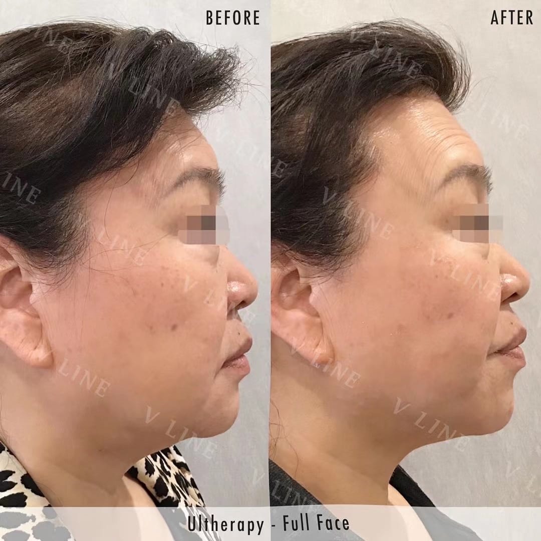 Ultherapy Before & After Gallery - Patient 133227592 - Image 2