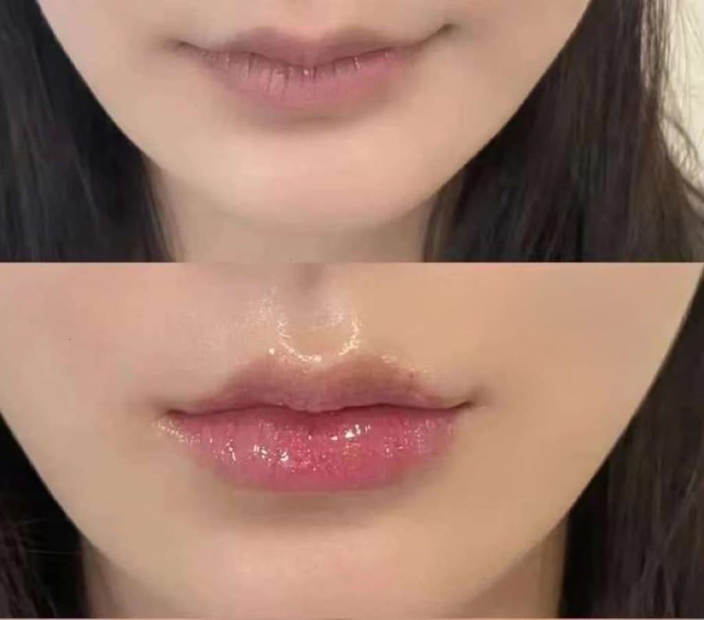 Dermal Fillers Before & After Gallery - Patient 133227524 - Image 1