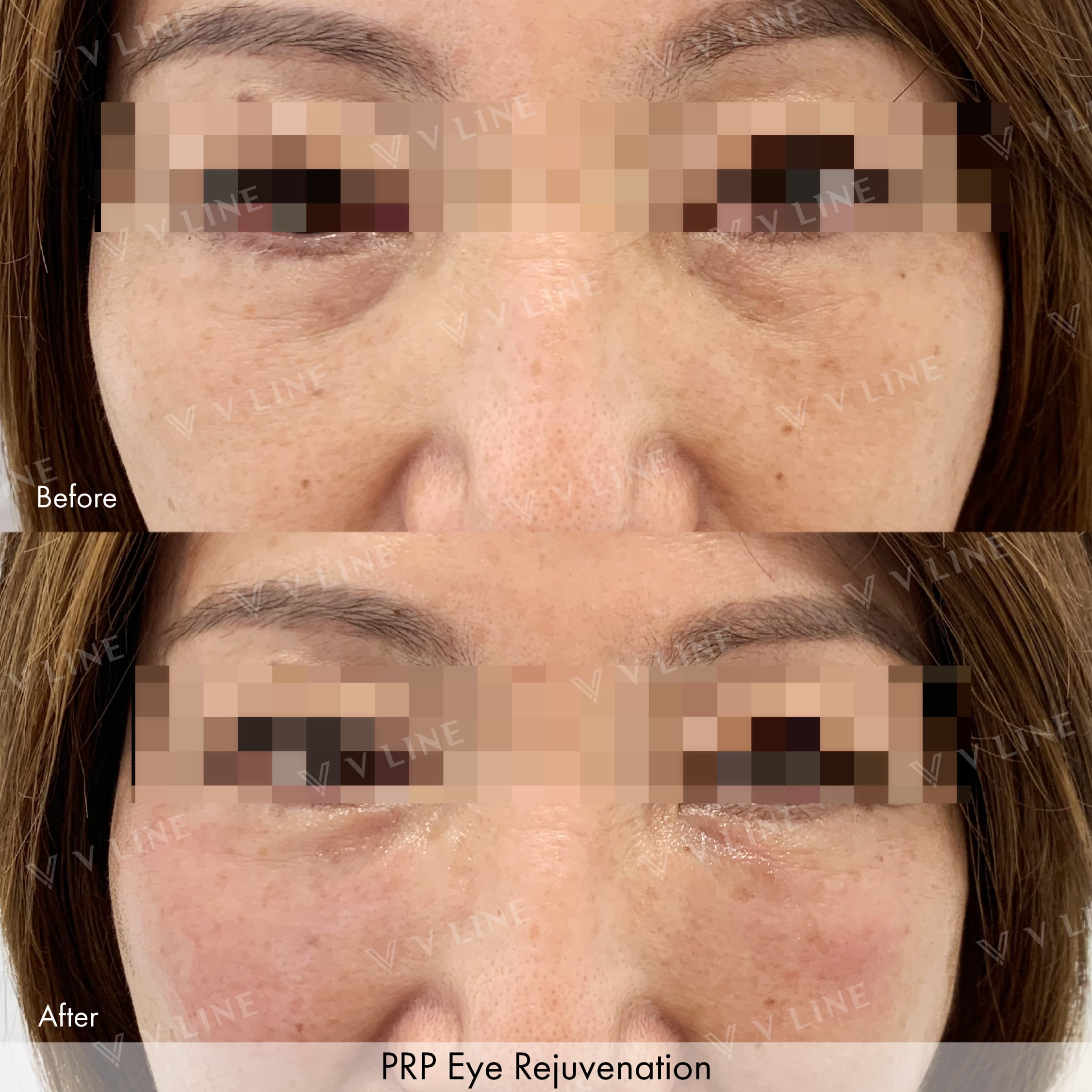 Platelet Rich Plasma Before & After Gallery - Patient 133235520 - Image 1