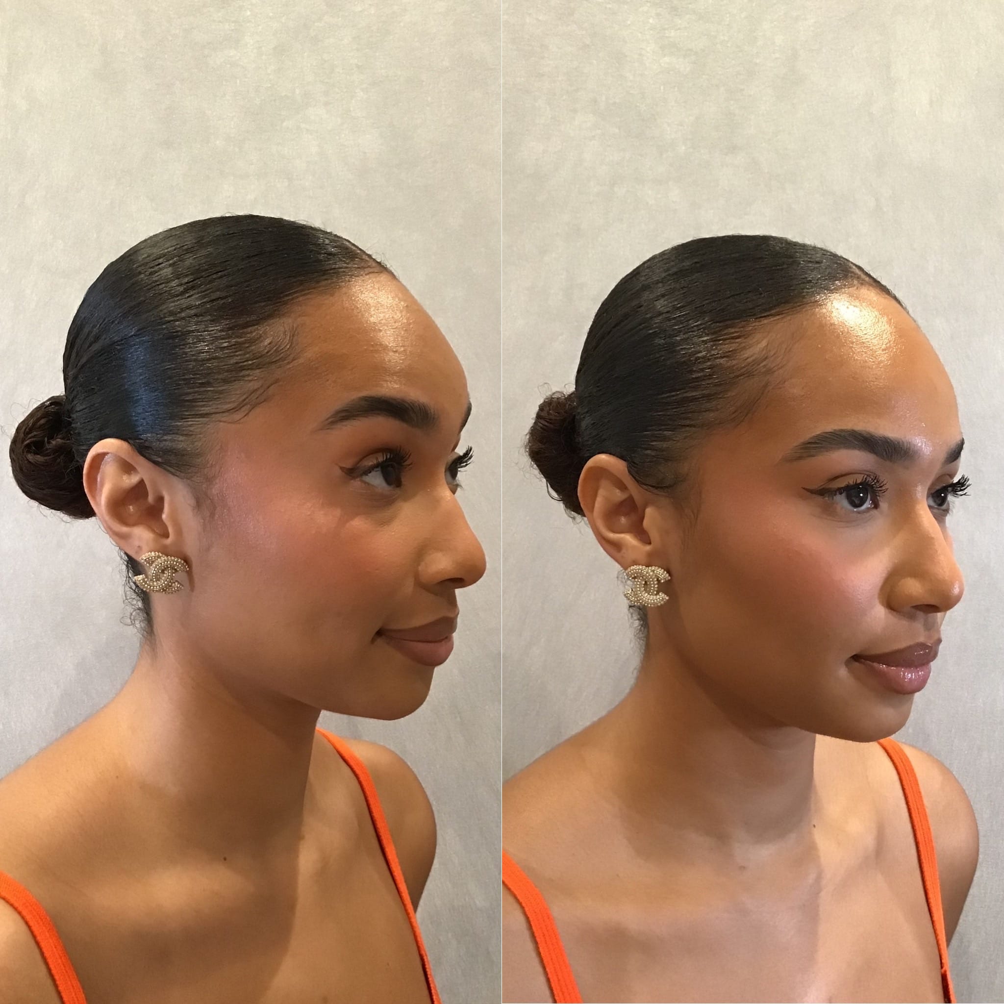 Wrinkle Relaxers Before & After Gallery - Patient 133235259 - Image 2