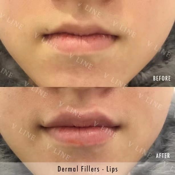 Dermal Fillers Before & After Gallery - Patient 133227522 - Image 1