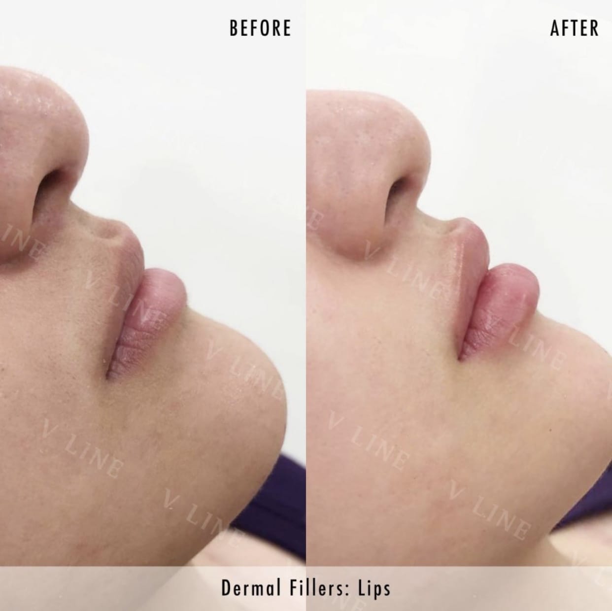 Dermal Fillers Before & After Gallery - Patient 133227495 - Image 1