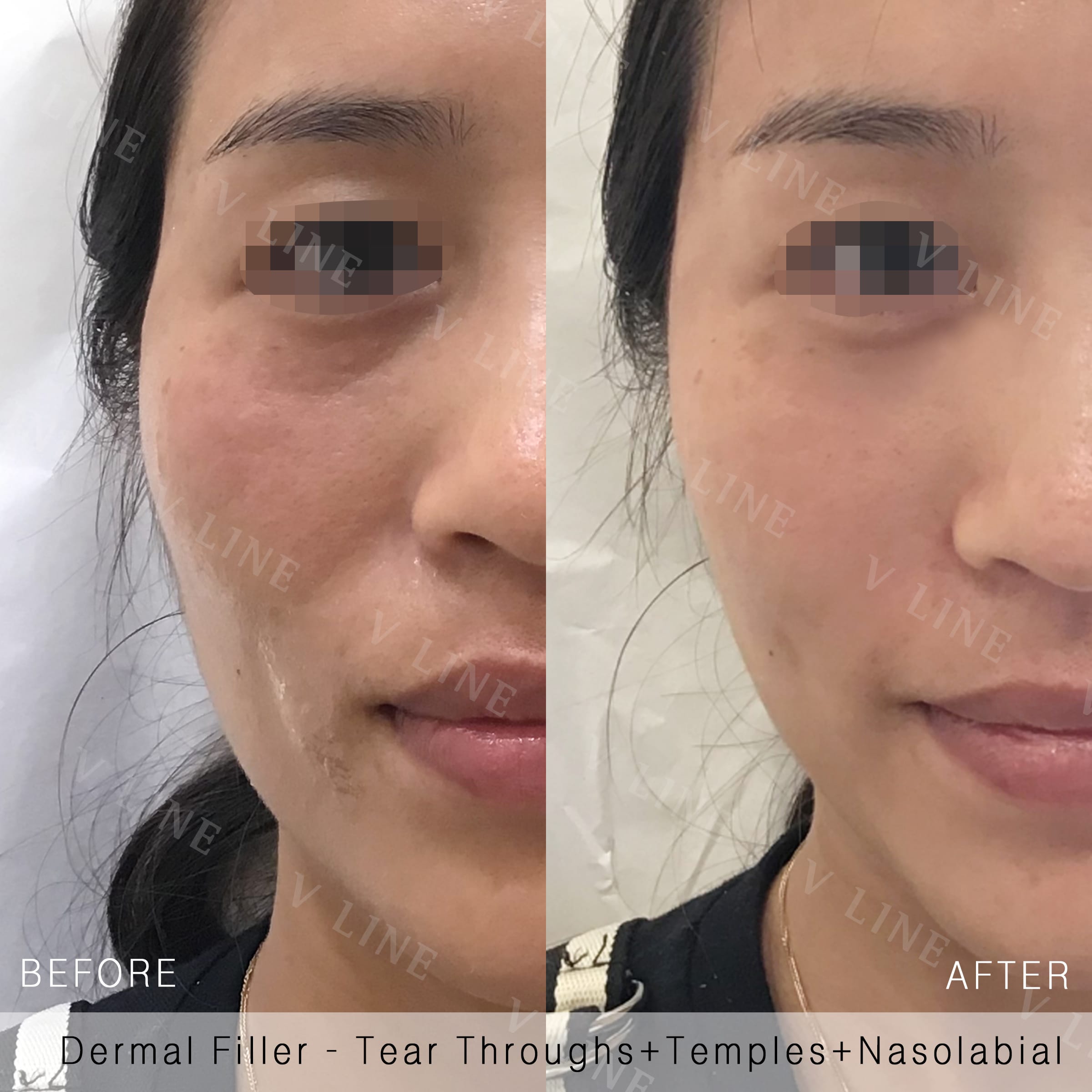 Dermal Fillers Before & After Gallery - Patient 133227485 - Image 1