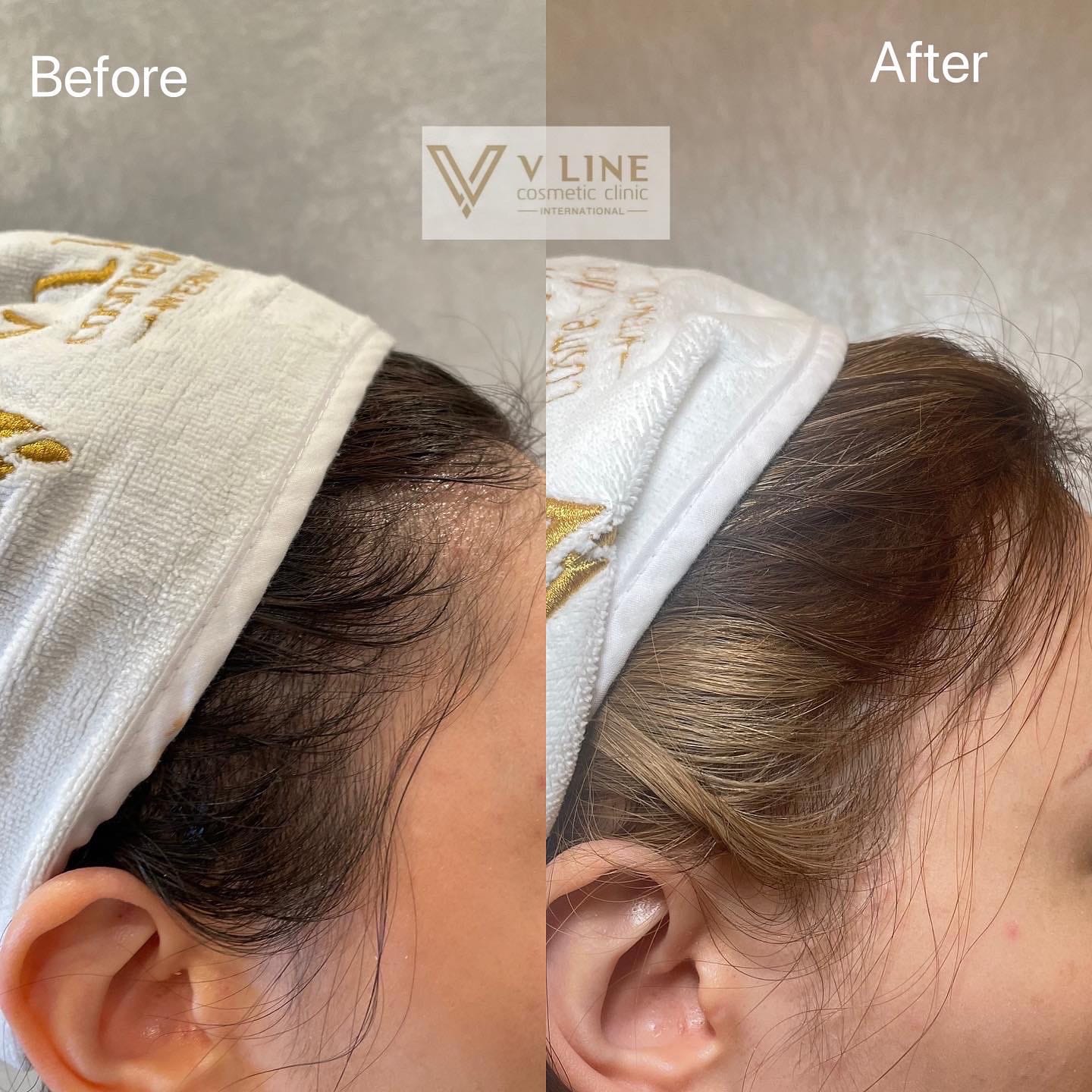 Hair Treatment Before & After Gallery - Patient 133227648 - Image 2