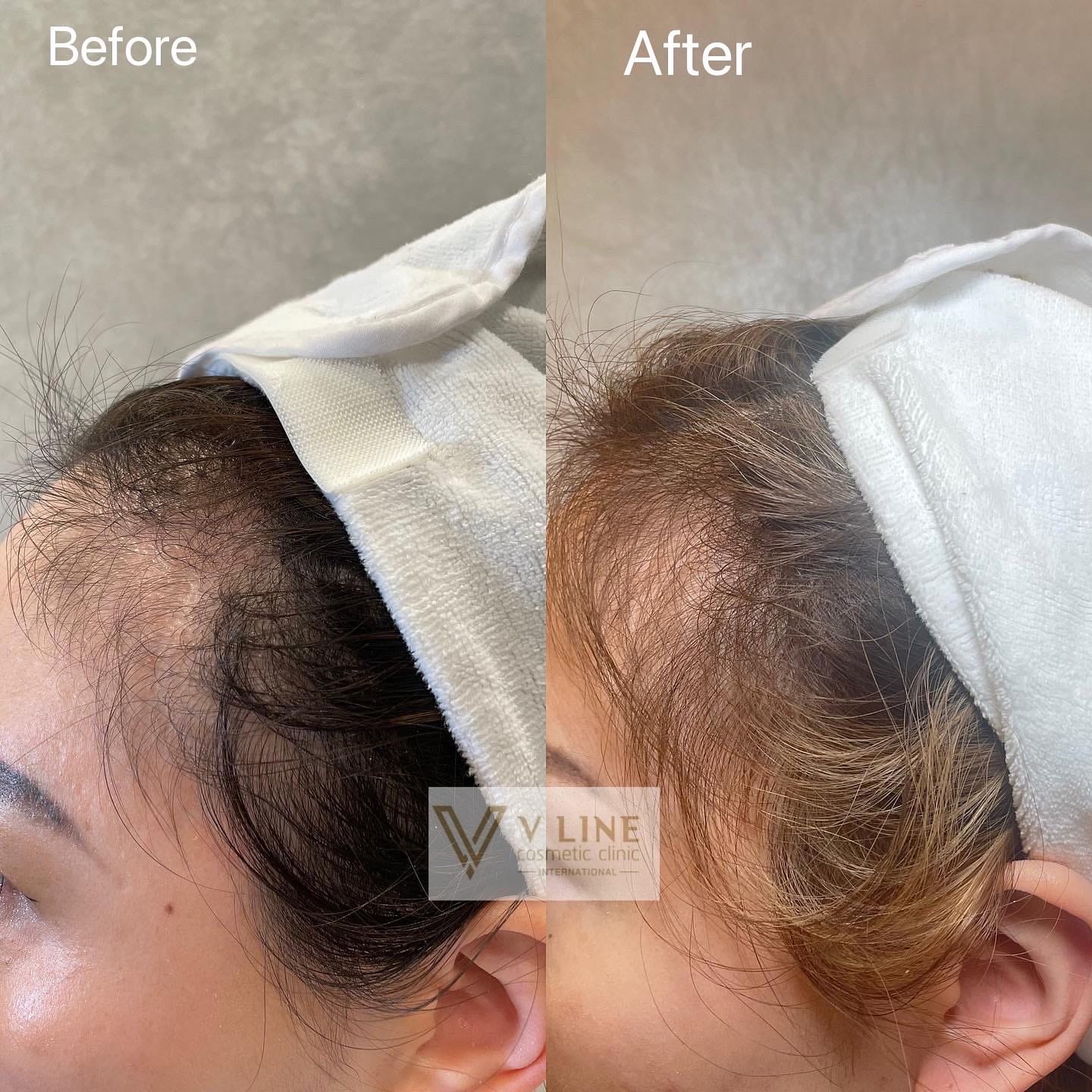 Hair Treatment Before & After Gallery - Patient 133227648 - Image 1