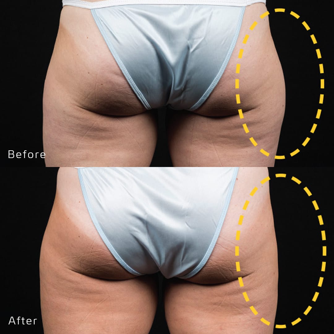 CoolSculpting Before & After Gallery - Patient 133227636 - Image 1