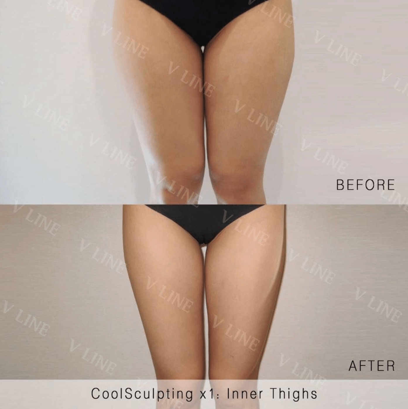 CoolSculpting Before & After Gallery - Patient 133236232 - Image 1