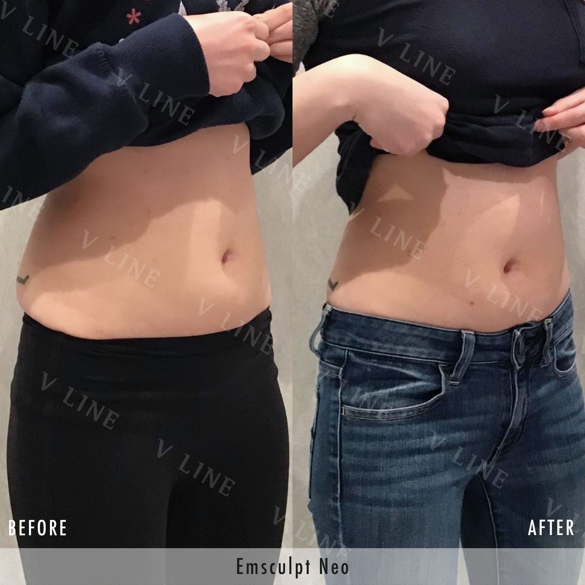 EmSculpt Before & After Gallery - Patient 133227568 - Image 1