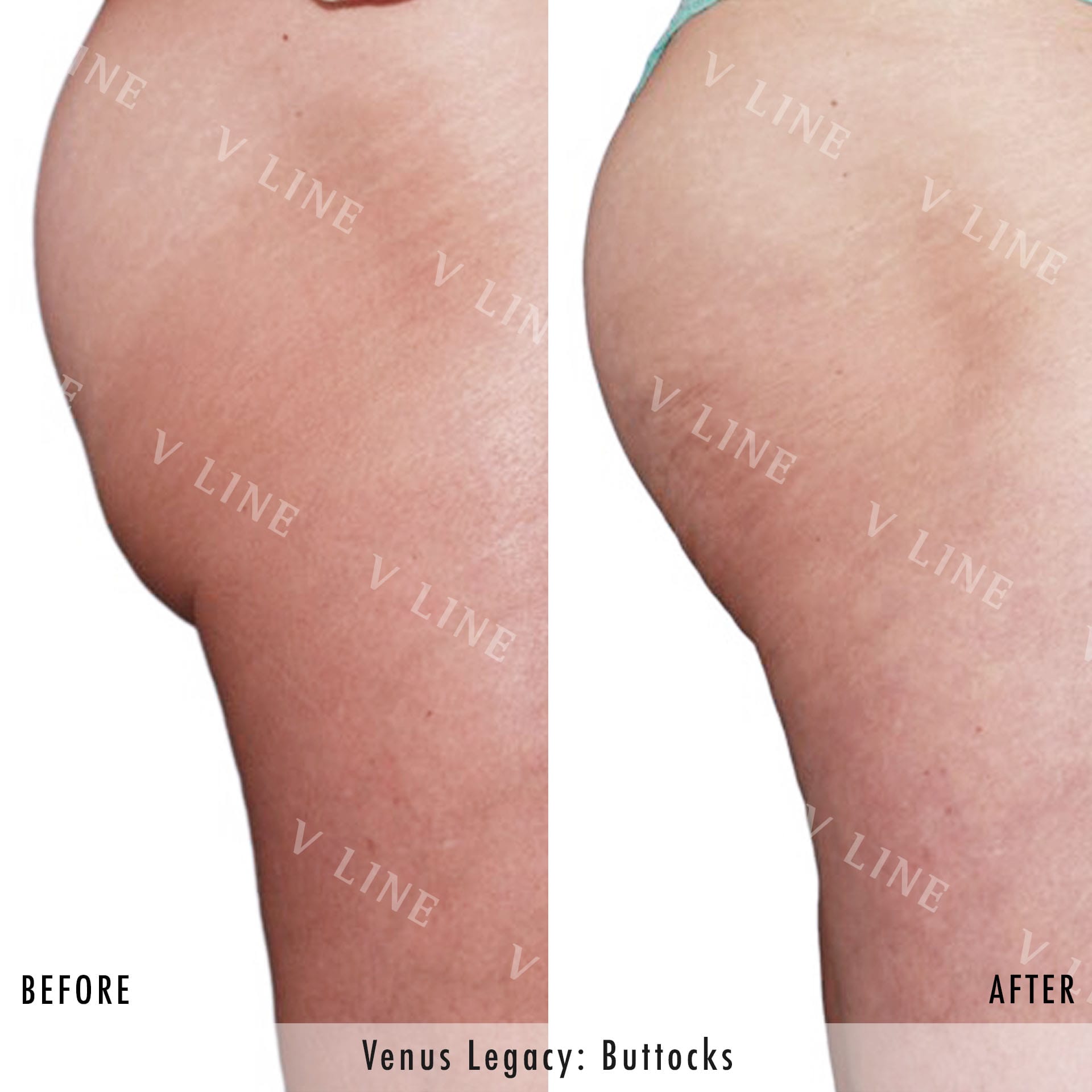 Venus Legacy Before & After Gallery - Patient 133236218 - Image 1