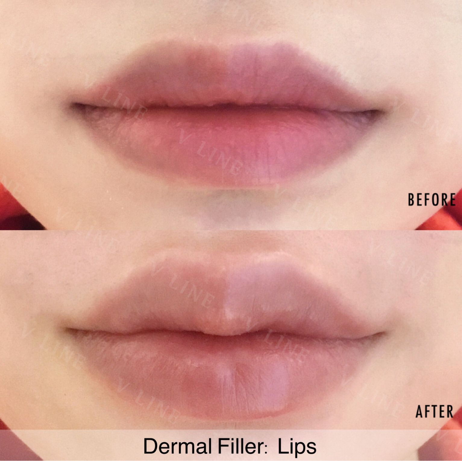 Dermal Fillers Before & After Gallery - Patient 133227332 - Image 1