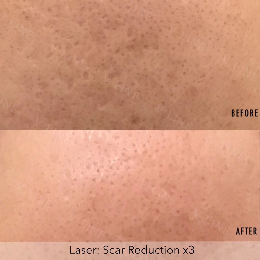 Scar Treatment Before & After Gallery - Patient 133236016 - Image 1