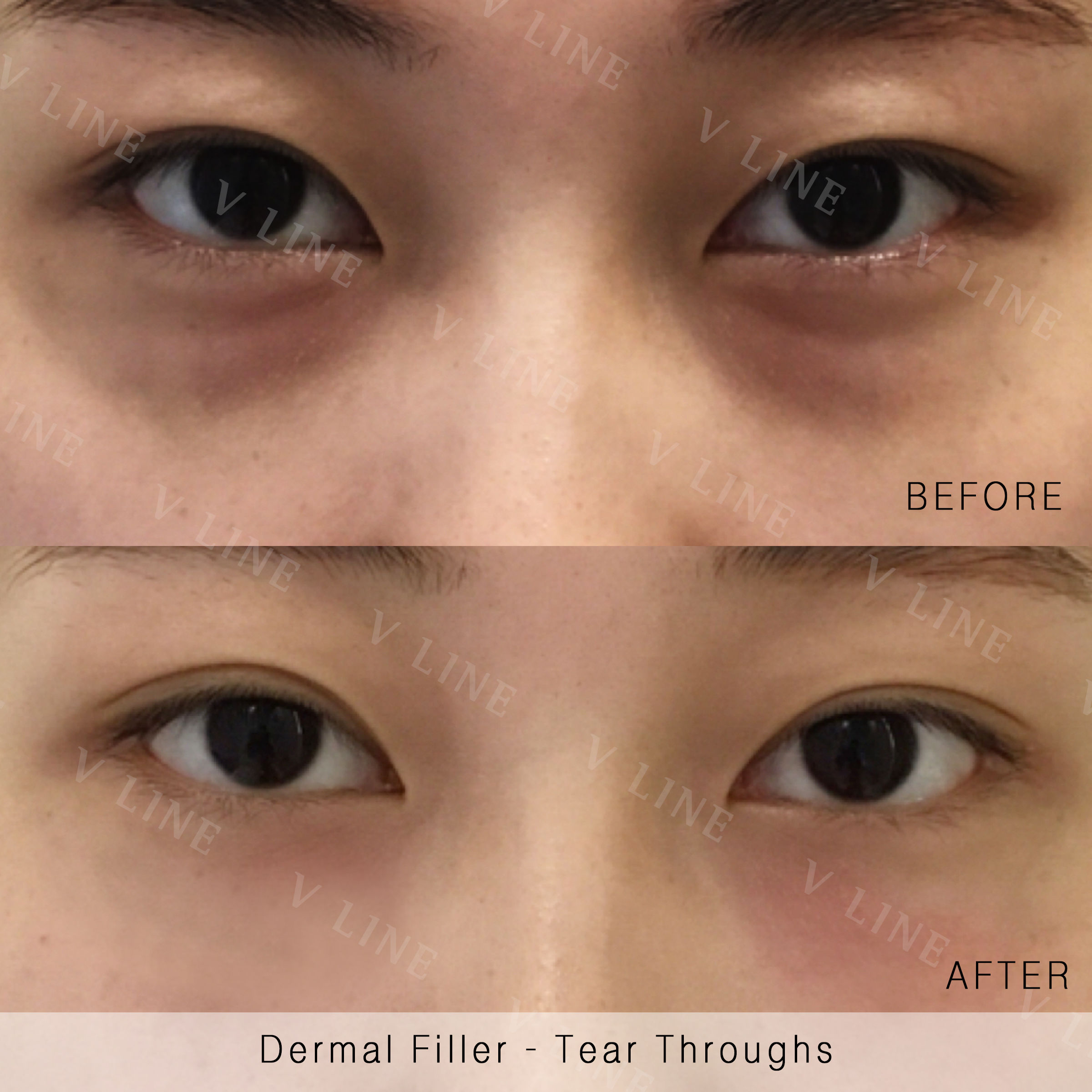 Dermal Fillers Before & After Gallery - Patient 133227324 - Image 1