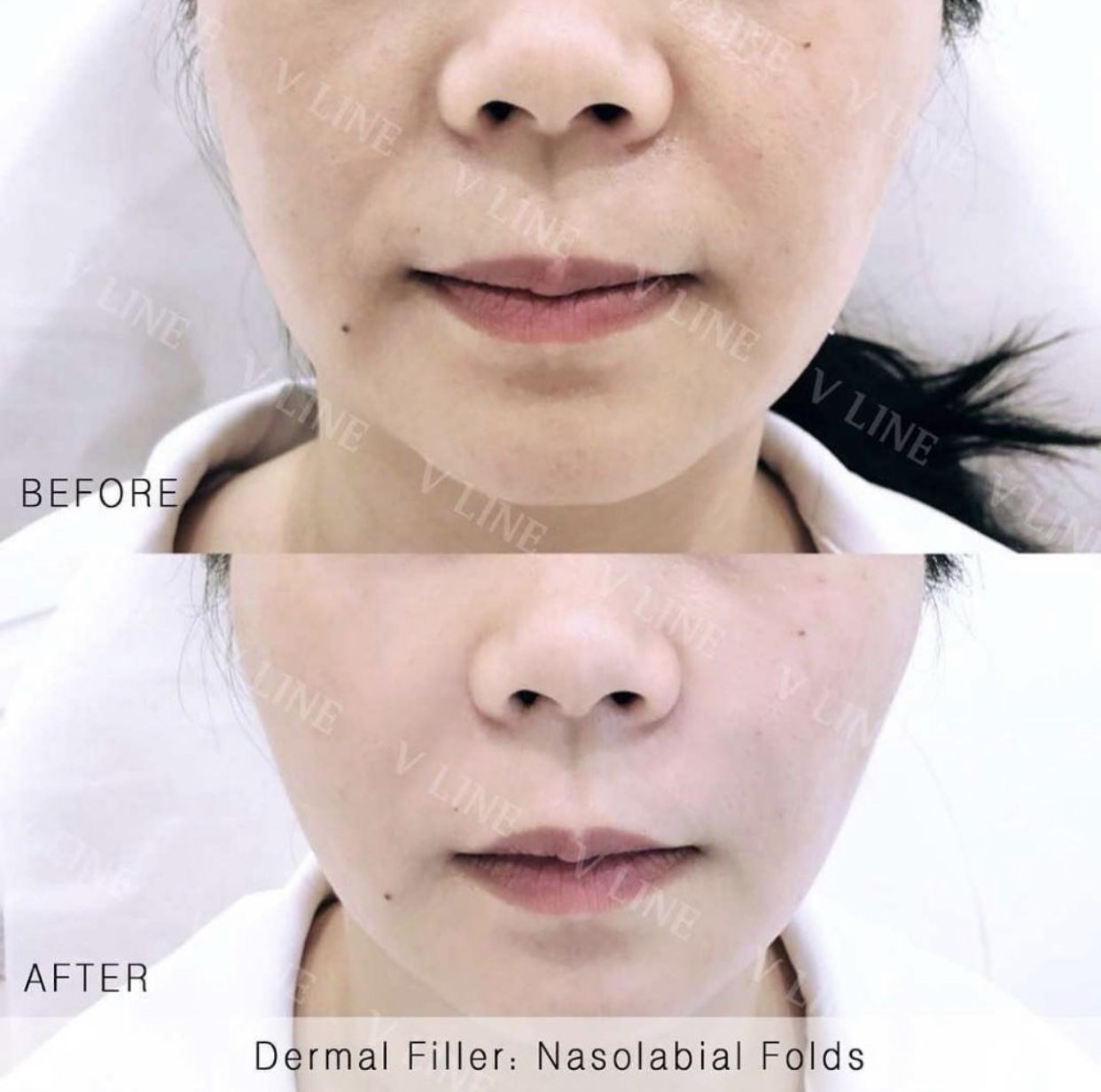 Dermal Fillers Before & After Gallery - Patient 133227328 - Image 1