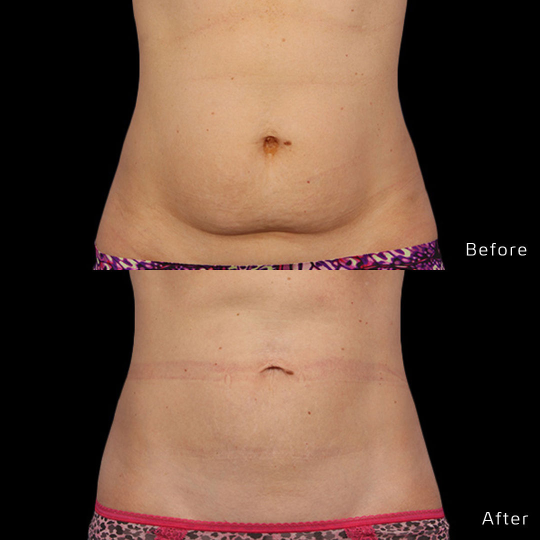 CoolSculpting Before & After Gallery - Patient 133227393 - Image 1