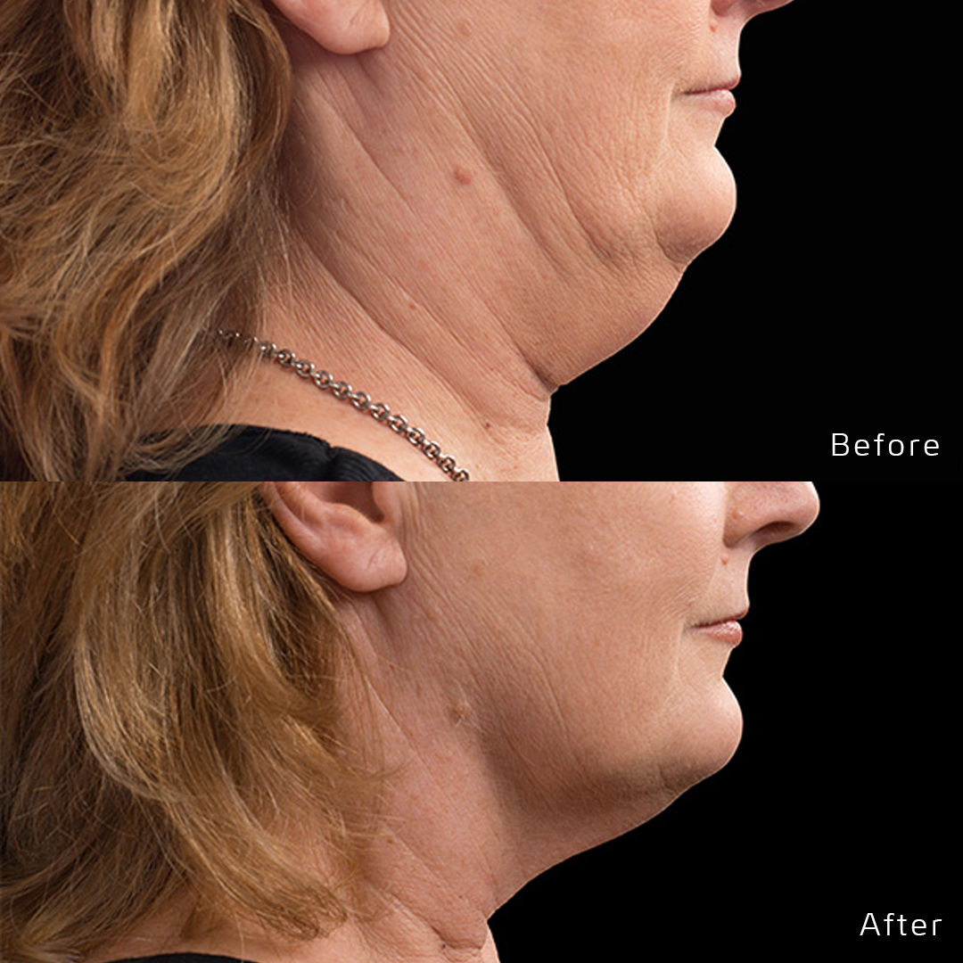 CoolSculpting Before & After Gallery - Patient 133227395 - Image 1