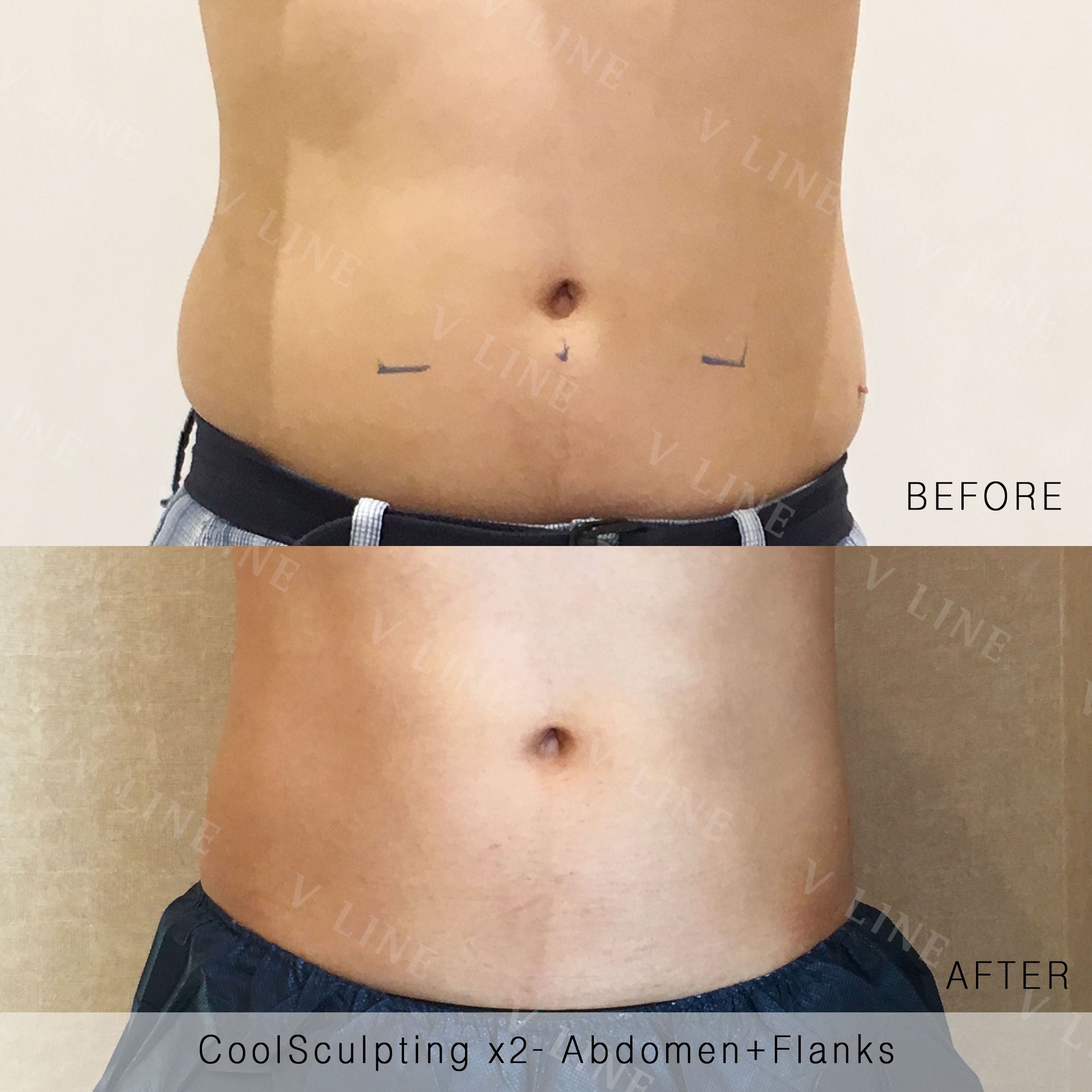 CoolSculpting Before & After Gallery - Patient 133227390 - Image 1