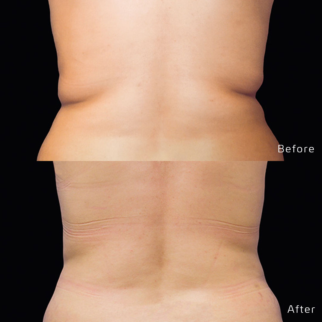 CoolSculpting Before & After Gallery - Patient 133227391 - Image 1