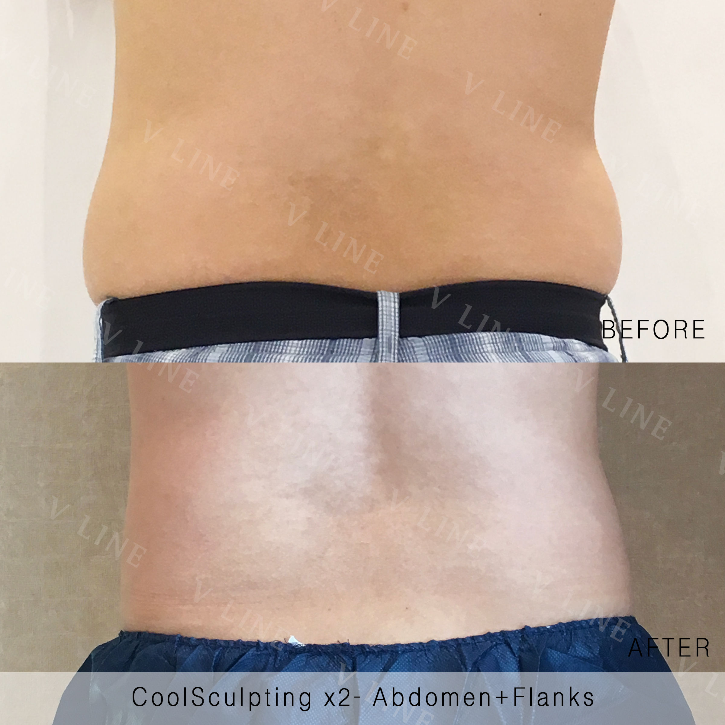 CoolSculpting Before & After Gallery - Patient 133227389 - Image 1