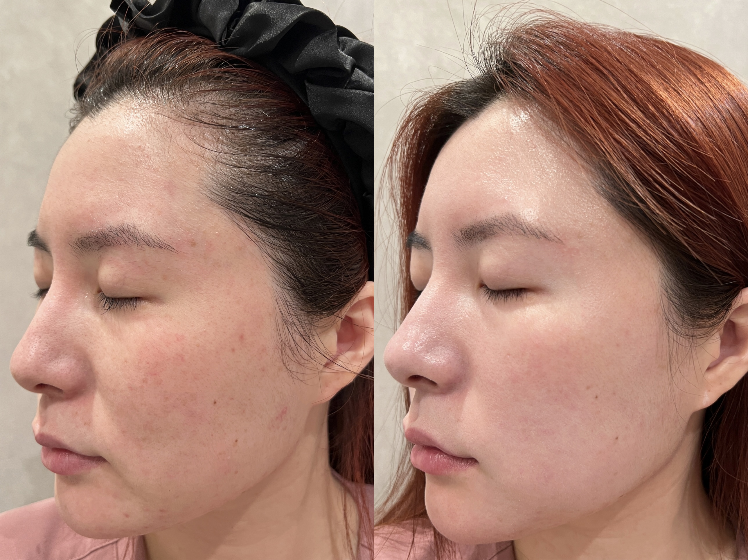 Sylfirm X Microneedling Before & After Gallery - Patient 133264971 - Image 1